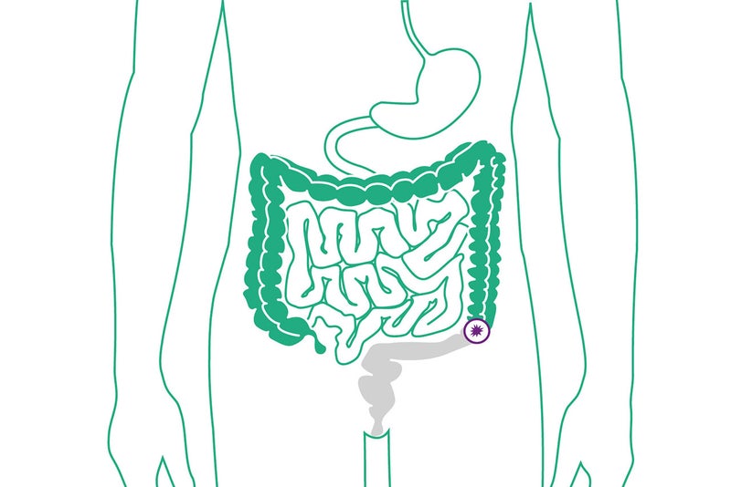 Schaubild eines endständigen Kolostomas am Dünndarm. 