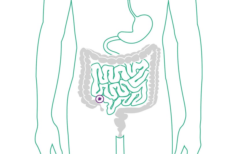 Schaubild eines endständigen Ileostomas am Dünndarm. 