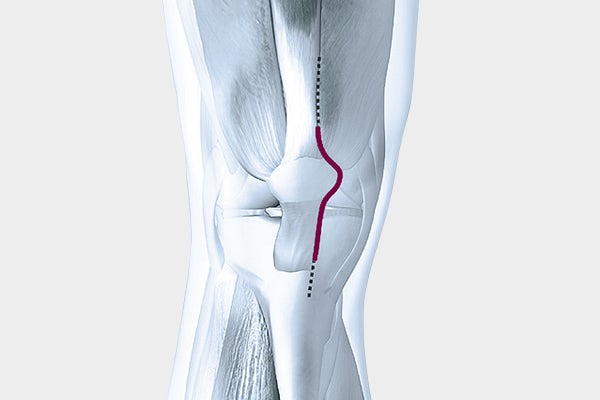 Operativer Zugang zum Kniegelenk