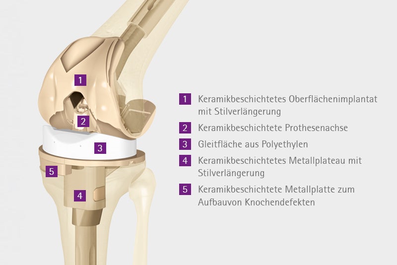 Achsgeführte Knieendoprothese