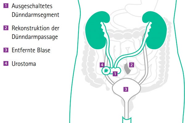 Schaubild eines Urostomas im rechten Unterbauch. 