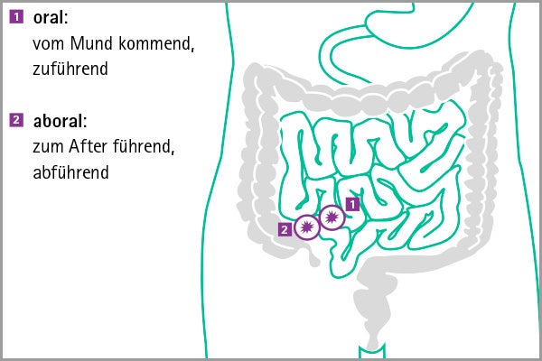 Schaubild eines doppelläufigen Ileostomas am Dünndarm mit einer oralen und aboralen Öffnung.