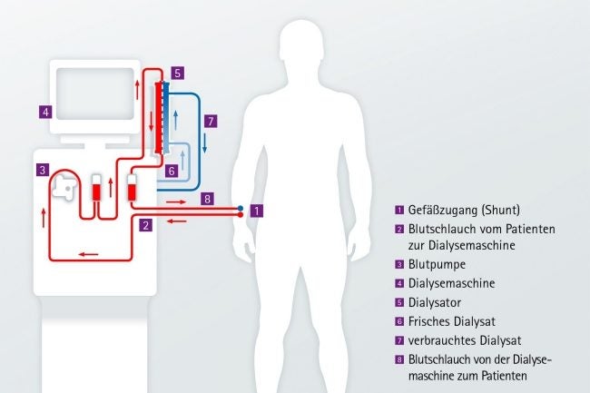 Schaubild zum Ablauf der Hämodialyse