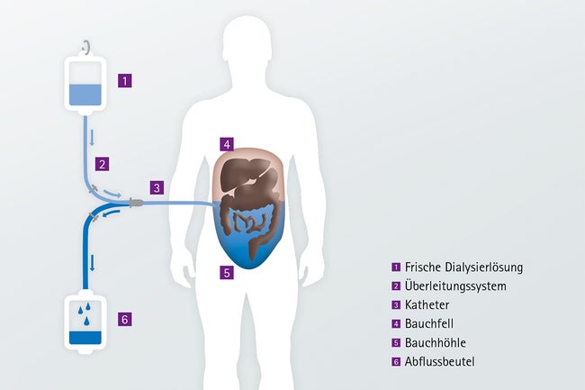 Grafische Darstellung des Ablaufs einer Peritonealdialyse