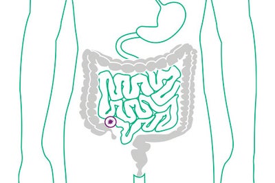 Schaubild eines Ileostomas. Das Ileostoma befindet sich am Dünndarm.