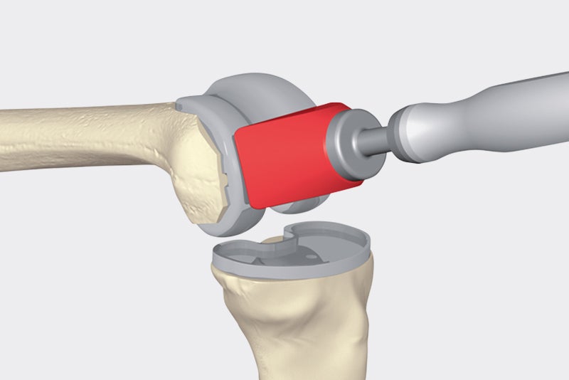 Implantation Oberschenkelimplantat