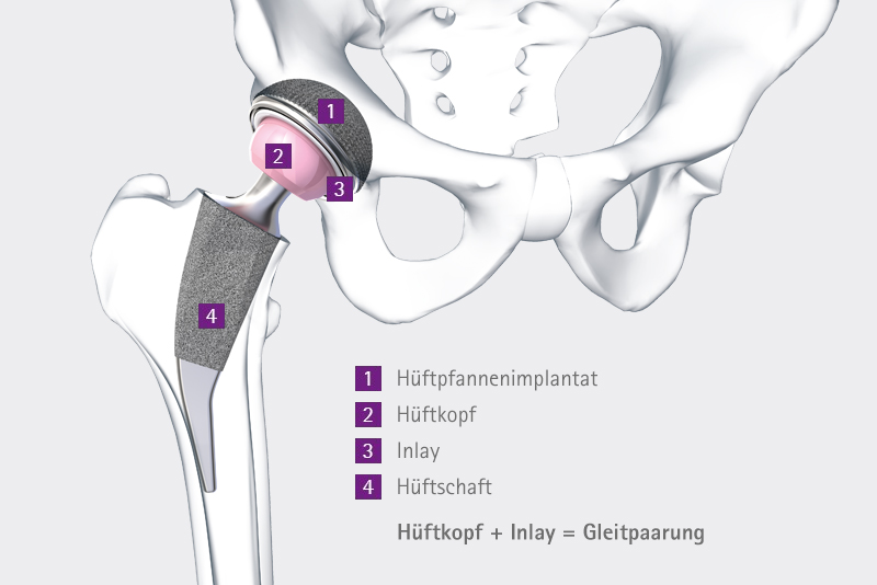 Künstliches Hüftgelenk